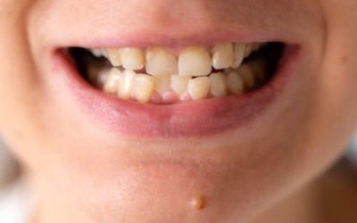 Oclusión dental y dolor de espalda: una conexión que no debes ignorar
