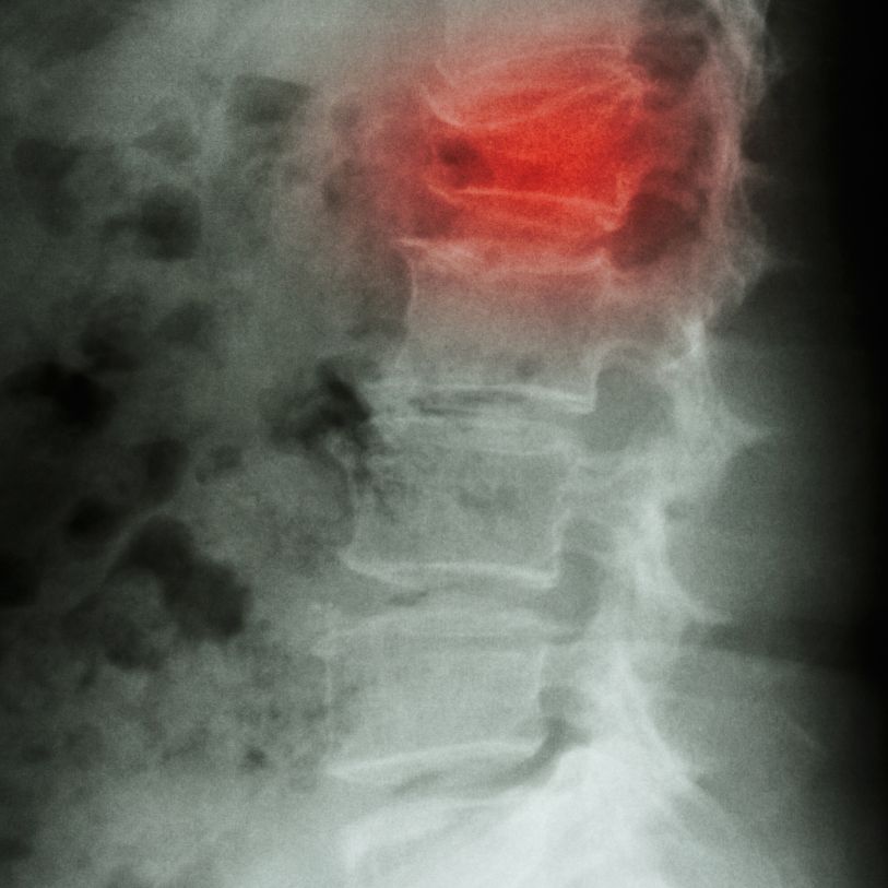 La charnela dorsolumbar: la piedra clave entre postura, respiración y dolor de espalda 3 fractura vertebral L1 por aplastamiento